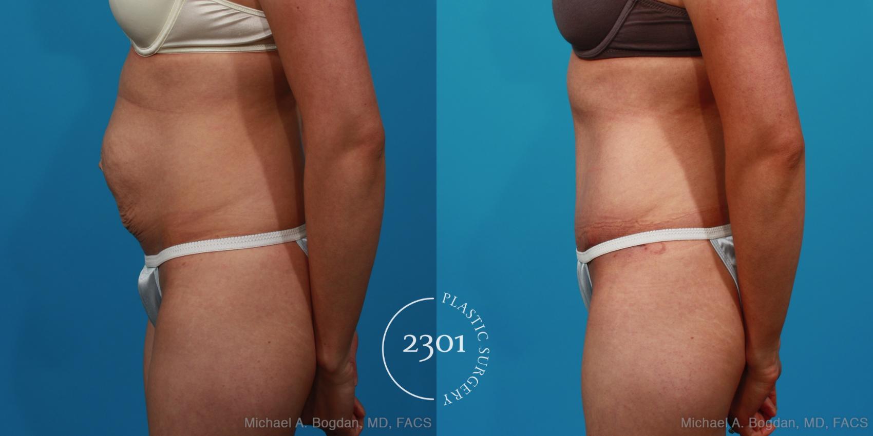 Before & After Tummy Tuck Case 235 View #2 View in Fort Worth, Plano, & Frisco, Texas