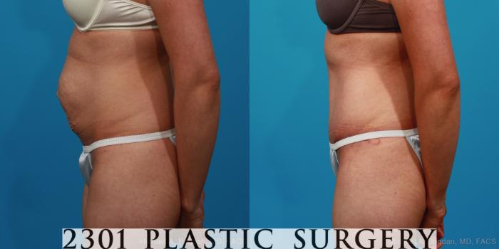 Before & After Tummy Tuck Case 235 View #2 View in Fort Worth, Plano, & Frisco, Texas