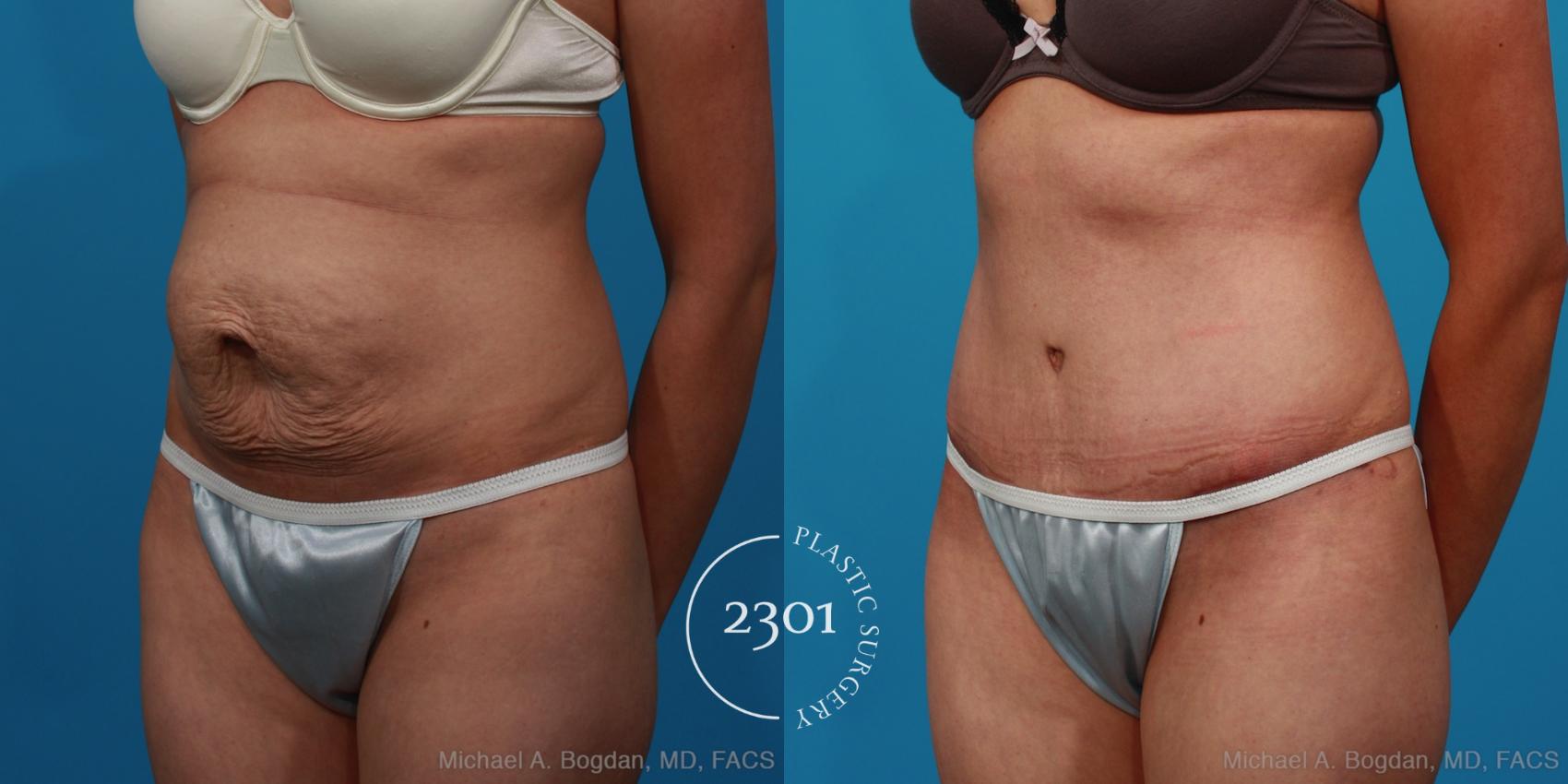 Before & After Tummy Tuck Case 235 View #3 View in Fort Worth, Plano, & Frisco, Texas