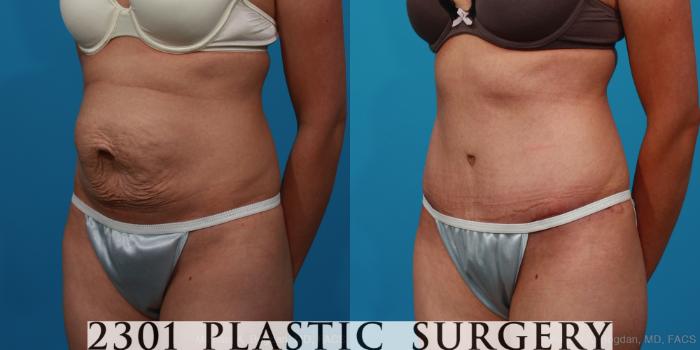 Before & After Tummy Tuck Case 235 View #3 View in Fort Worth, Plano, & Frisco, Texas