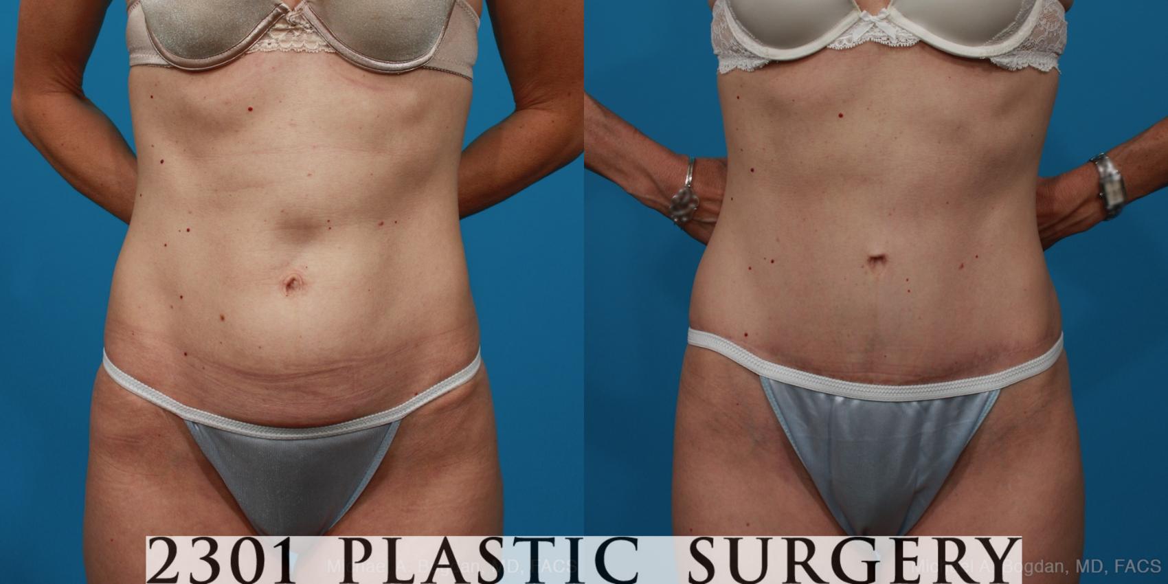 Before & After Tummy Tuck Case 279 View #1 View in Fort Worth, Plano, & Frisco, Texas