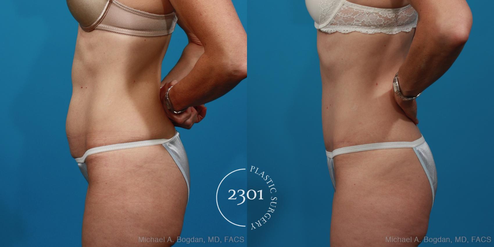 Before & After Tummy Tuck Case 279 View #2 View in Fort Worth, Plano, & Frisco, Texas