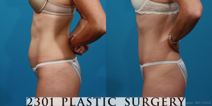 Before & After Tummy Tuck Case 279 View #2 View in Fort Worth, Plano, & Frisco, Texas