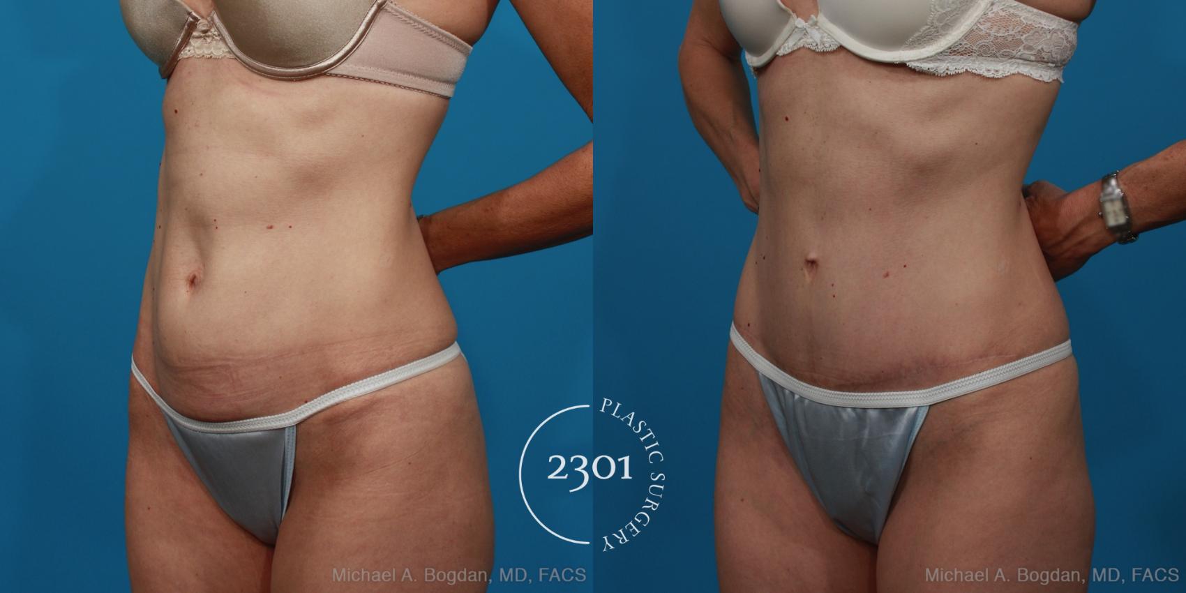 Before & After Tummy Tuck Case 279 View #3 View in Fort Worth, Plano, & Frisco, Texas