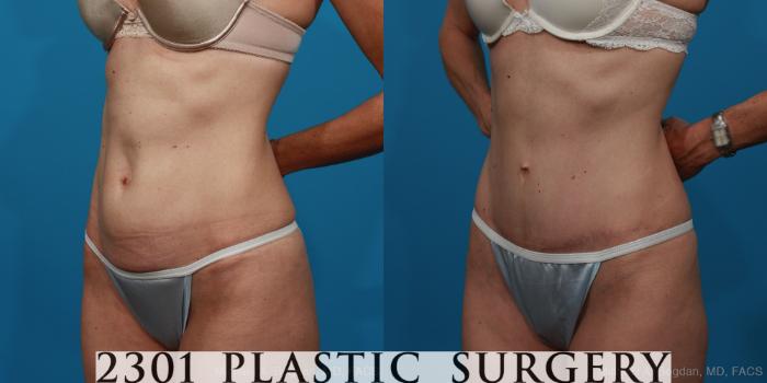 Before & After Tummy Tuck Case 279 View #3 View in Fort Worth, Plano, & Frisco, Texas