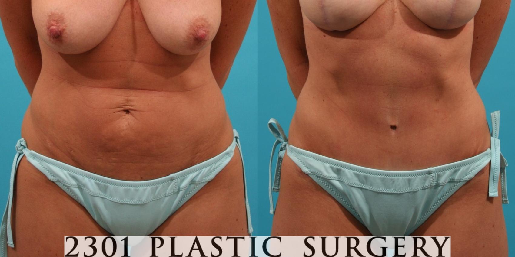 Before & After Tummy Tuck Case 29 View #1 View in Fort Worth, Plano, & Frisco, Texas