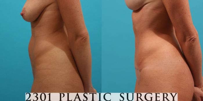 Before & After Tummy Tuck Case 29 View #2 View in Fort Worth, Plano, & Frisco, Texas