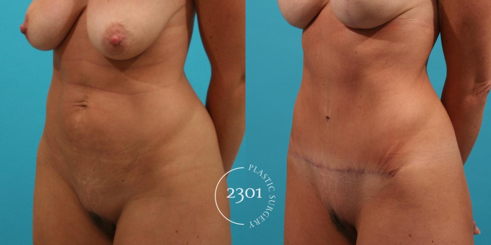 Before & After Tummy Tuck Case 29 View #3 View in Fort Worth, Plano, & Frisco, Texas