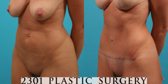Before & After Tummy Tuck Case 29 View #3 View in Fort Worth, Plano, & Frisco, Texas