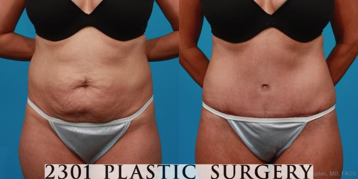 Before & After Liposuction Case 294 View #1 View in Fort Worth & Frisco, Texas