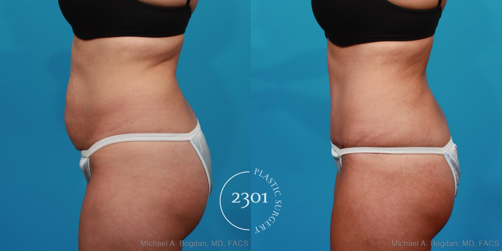 Before & After Liposuction Case 294 View #2 View in Fort Worth, Plano, & Frisco, Texas