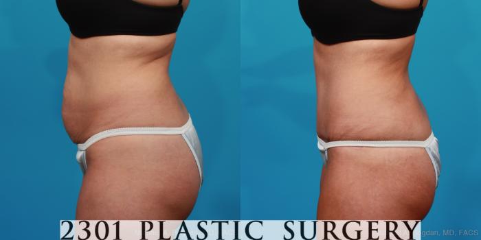 Before & After Tummy Tuck Case 294 View #2 View in Fort Worth, Plano, & Frisco, Texas