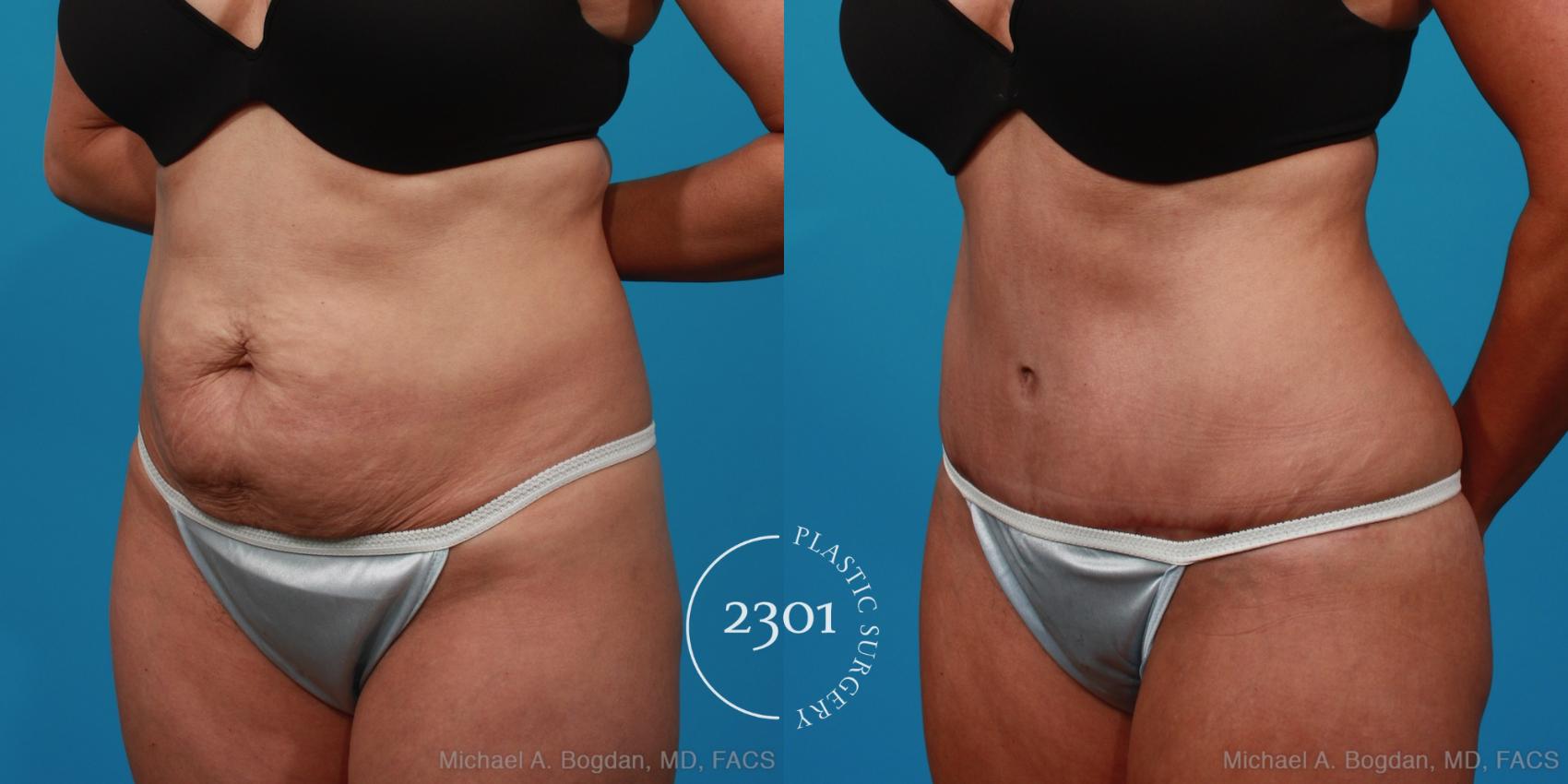 Before & After Liposuction Case 294 View #3 View in Fort Worth, Plano, & Frisco, Texas