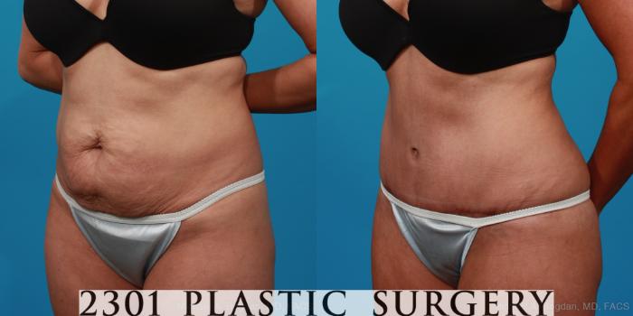 Before & After Liposuction Case 294 View #3 View in Fort Worth, Plano, & Frisco, Texas