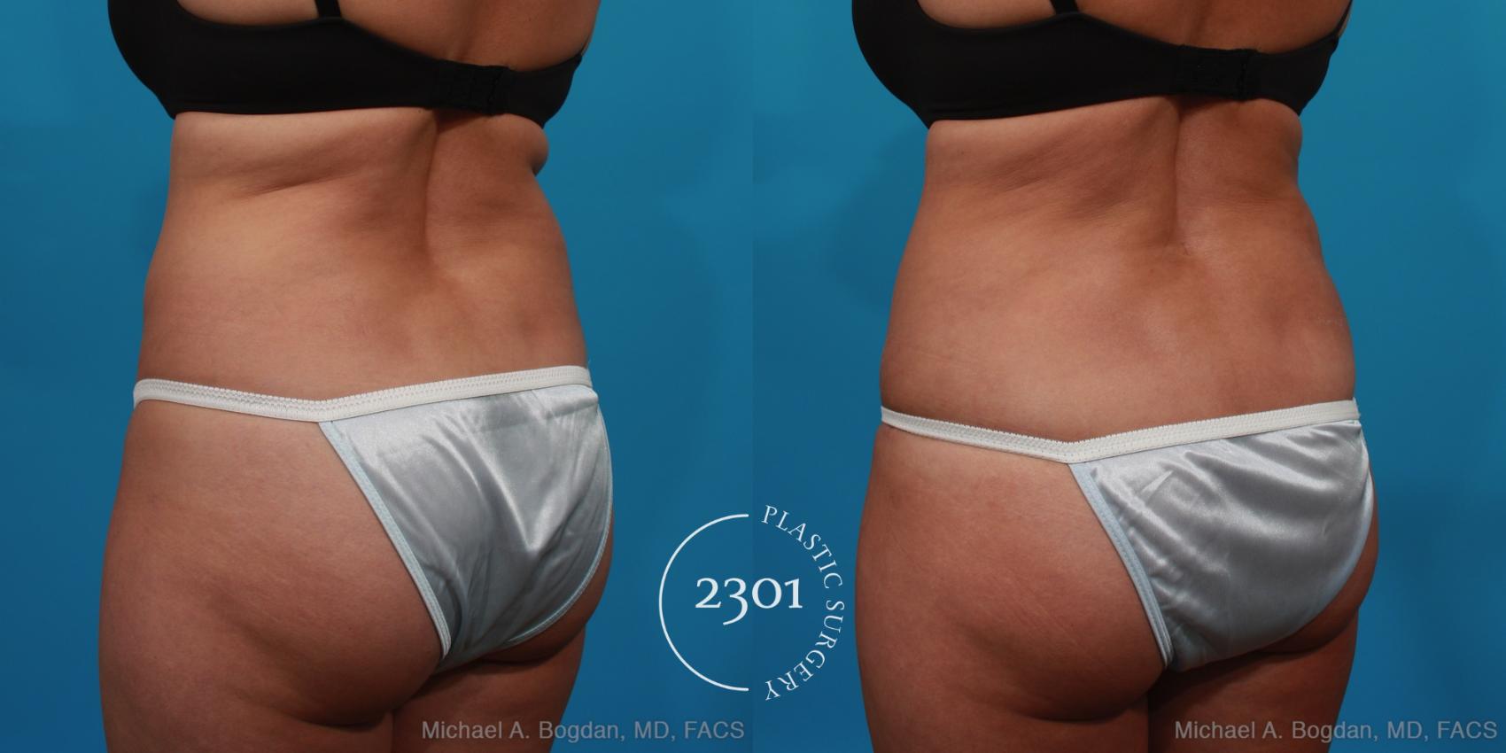Before & After Liposuction Case 294 View #4 View in Fort Worth, Plano, & Frisco, Texas