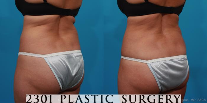 Before & After Tummy Tuck Case 294 View #4 View in Fort Worth, Plano, & Frisco, Texas