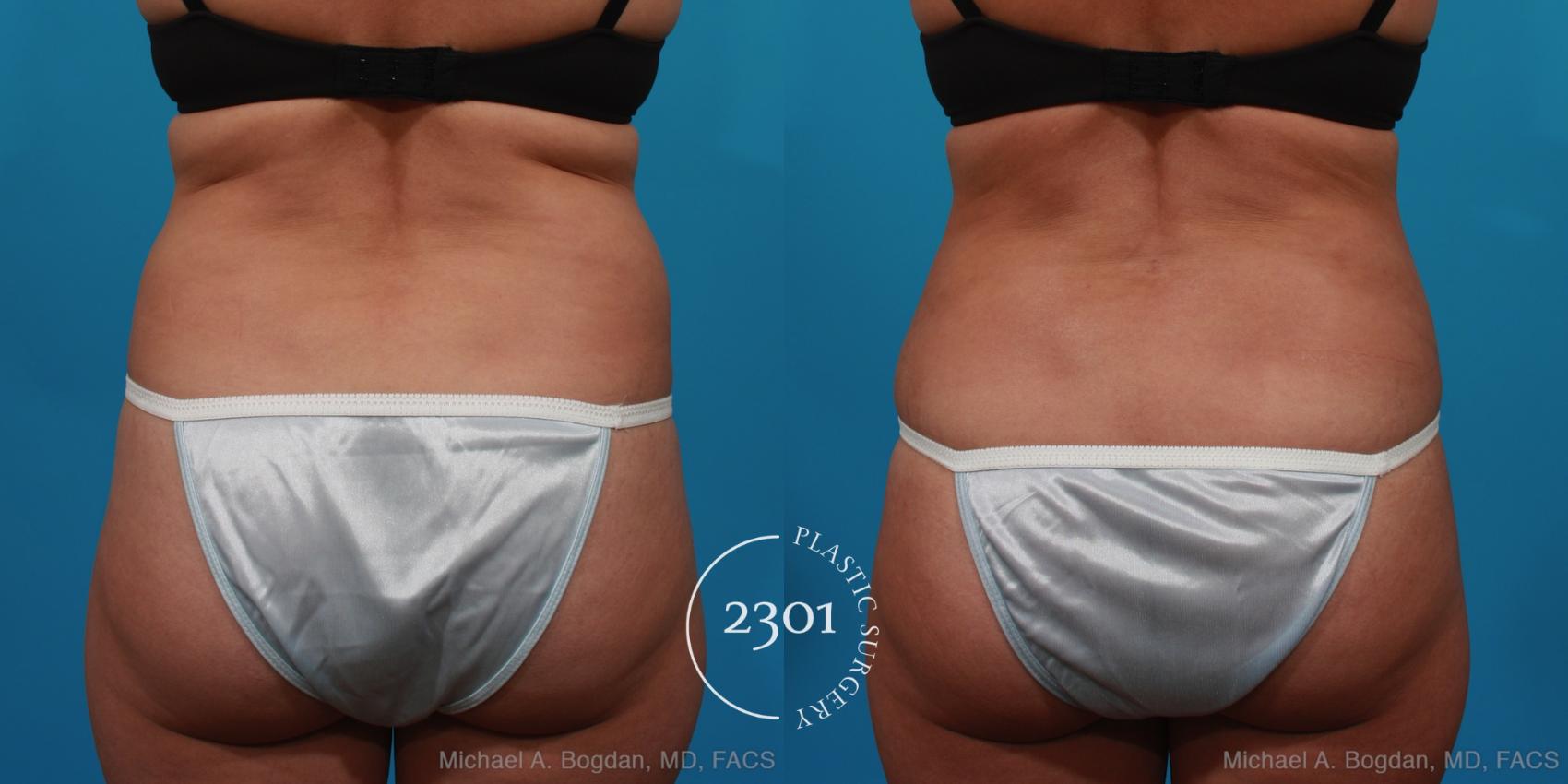 Before & After Liposuction Case 294 View #5 View in Fort Worth, Plano, & Frisco, Texas