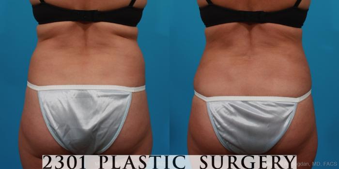 Before & After Tummy Tuck Case 294 View #5 View in Fort Worth, Plano, & Frisco, Texas