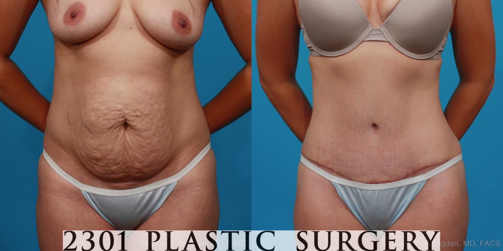 Before & After Tummy Tuck Case 296 View #1 View in Fort Worth, Plano, & Frisco, Texas