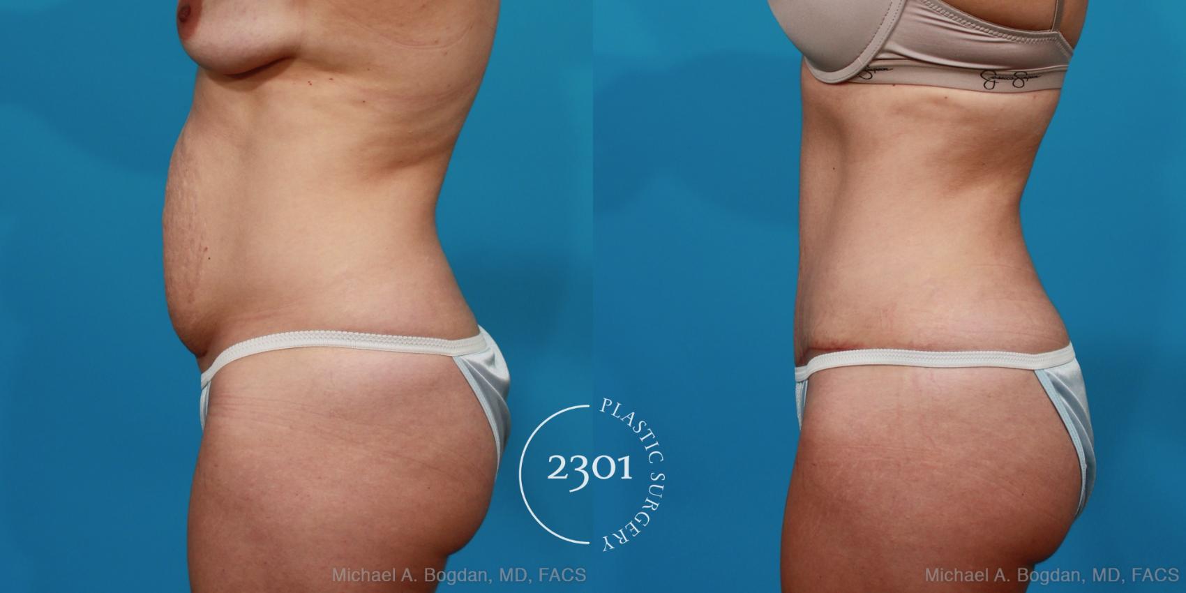 Before & After Tummy Tuck Case 296 View #2 View in Fort Worth, Plano, & Frisco, Texas