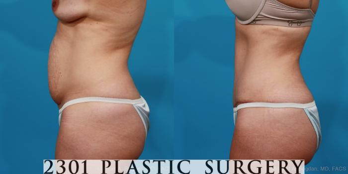Before & After Liposuction Case 296 View #2 View in Fort Worth, Plano, & Frisco, Texas