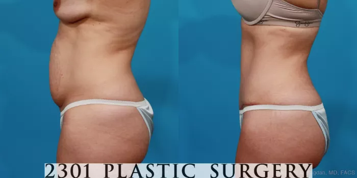 Tummy Tuck Before and After Pictures Case 171, Naples and Ft. Myers, FL