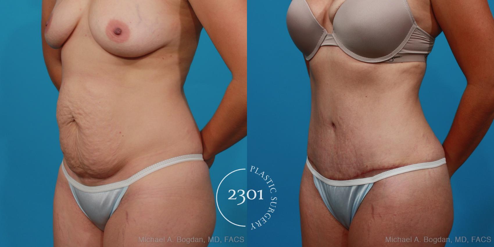 Before & After Tummy Tuck Case 296 View #3 View in Fort Worth, Plano, & Frisco, Texas
