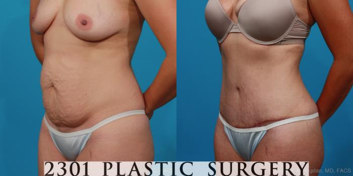 Before & After Tummy Tuck Case 296 View #3 View in Fort Worth, Plano, & Frisco, Texas