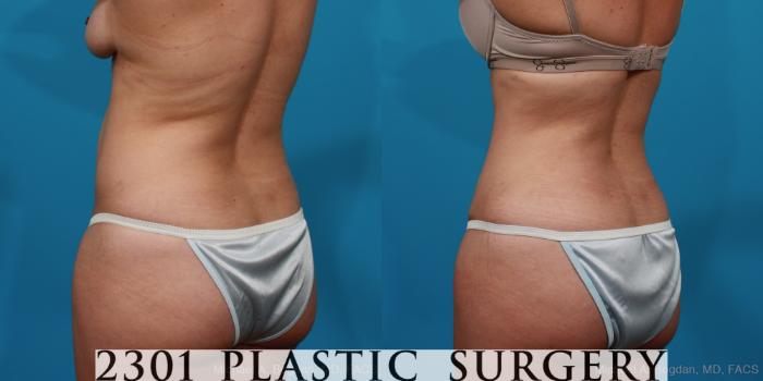 Before & After Liposuction Case 296 View #4 View in Fort Worth, Plano, & Frisco, Texas
