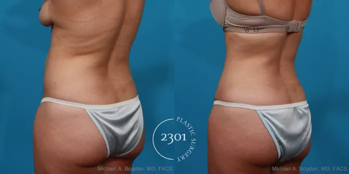 Tummy Tuck Before and After Pictures Case 296, Fort Worth, Plano, &  Frisco, Texas