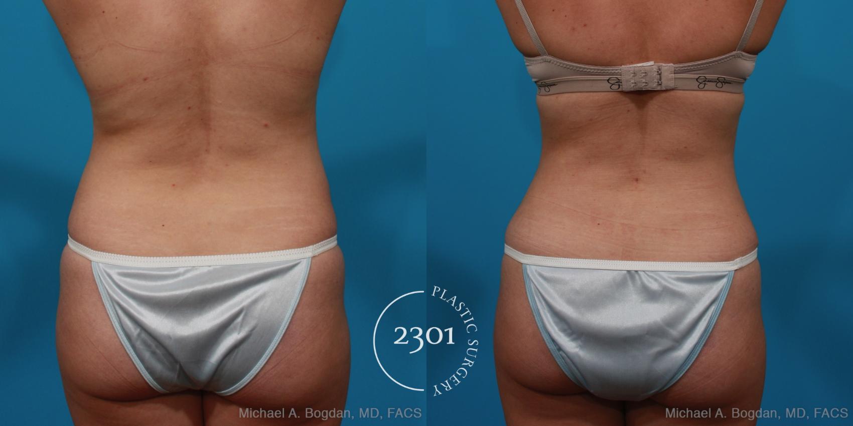 Before & After Tummy Tuck Case 296 View #5 View in Fort Worth, Plano, & Frisco, Texas