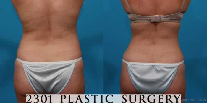 Before & After Tummy Tuck Case 296 View #5 View in Fort Worth, Plano, & Frisco, Texas