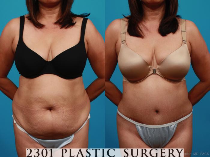 Before & After Tummy Tuck Case 316 View #1 View in Fort Worth, Plano, & Frisco, Texas