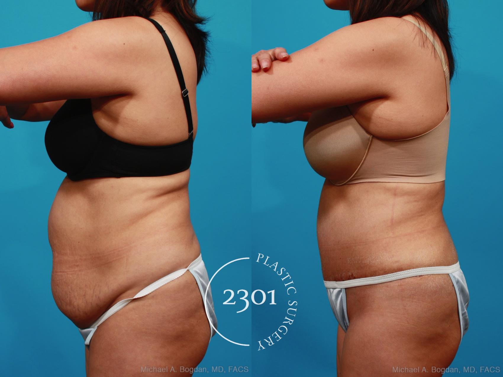Before & After Tummy Tuck Case 316 View #2 View in Fort Worth, Plano, & Frisco, Texas