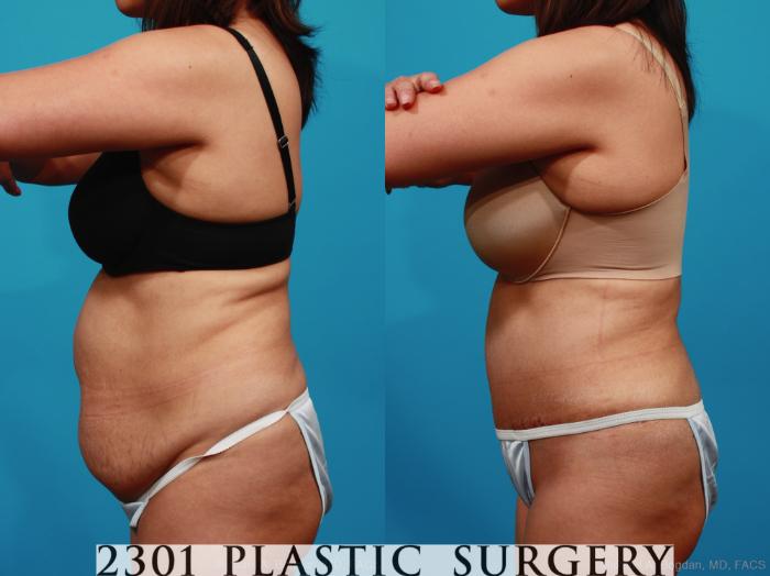 Before & After Tummy Tuck Case 316 View #2 View in Fort Worth, Plano, & Frisco, Texas
