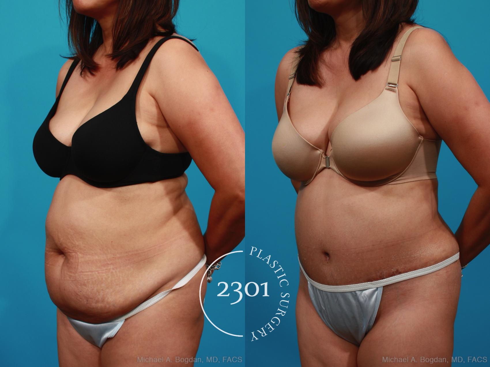 Before & After Tummy Tuck Case 316 View #3 View in Fort Worth, Plano, & Frisco, Texas