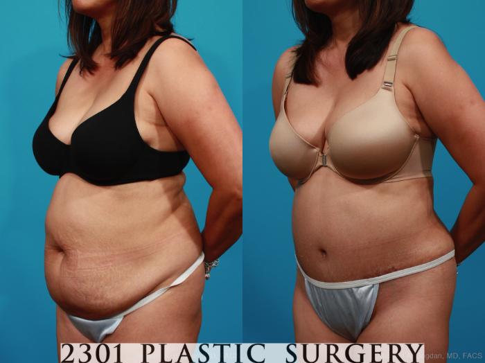 Before & After Tummy Tuck Case 316 View #3 View in Fort Worth, Plano, & Frisco, Texas