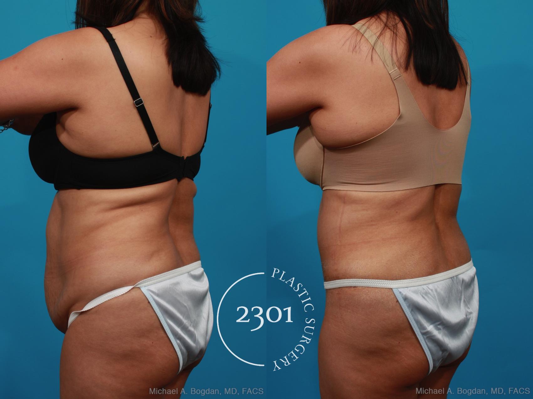 Before & After Tummy Tuck Case 316 View #4 View in Fort Worth, Plano, & Frisco, Texas