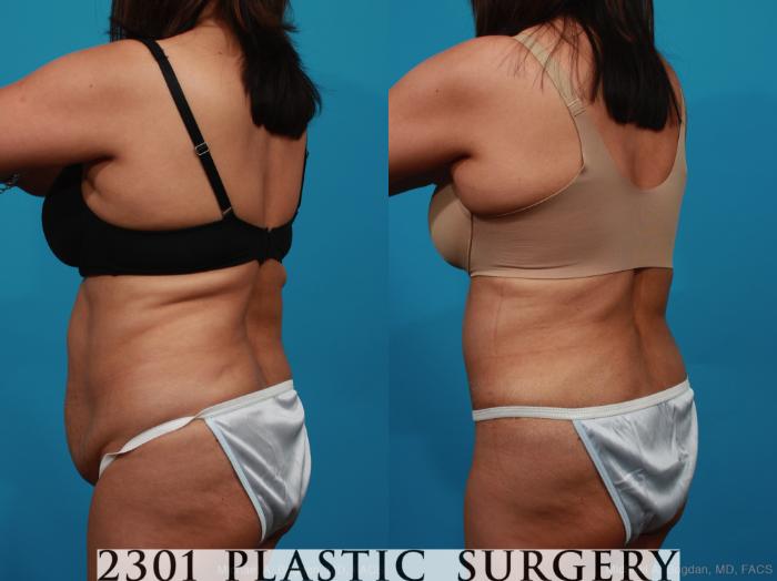 Before & After Tummy Tuck Case 316 View #4 View in Fort Worth, Plano, & Frisco, Texas