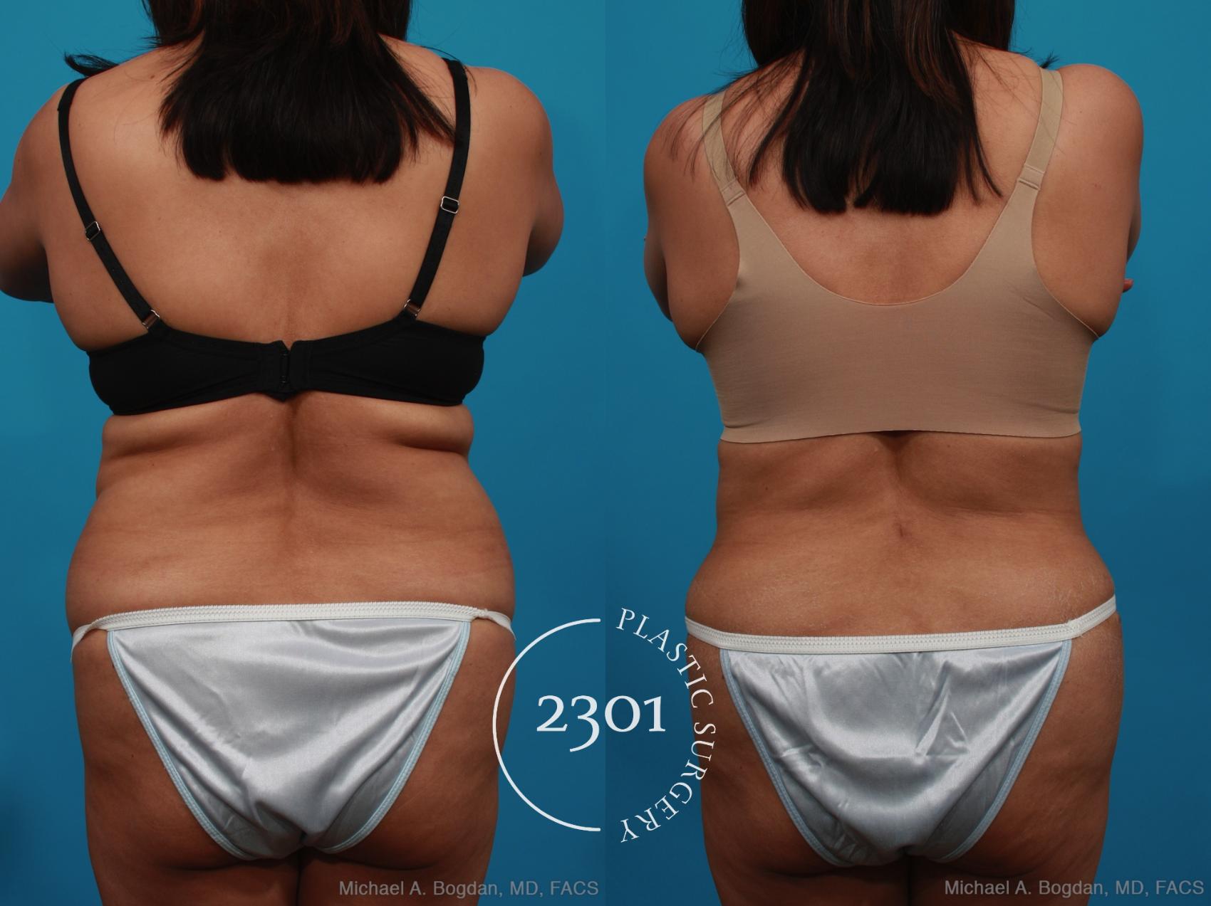Before & After Tummy Tuck Case 316 View #5 View in Fort Worth, Plano, & Frisco, Texas