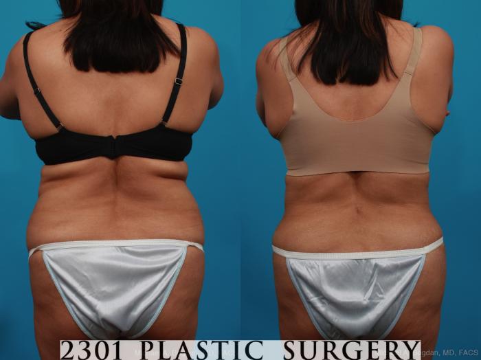 Before & After Tummy Tuck Case 316 View #5 View in Fort Worth, Plano, & Frisco, Texas