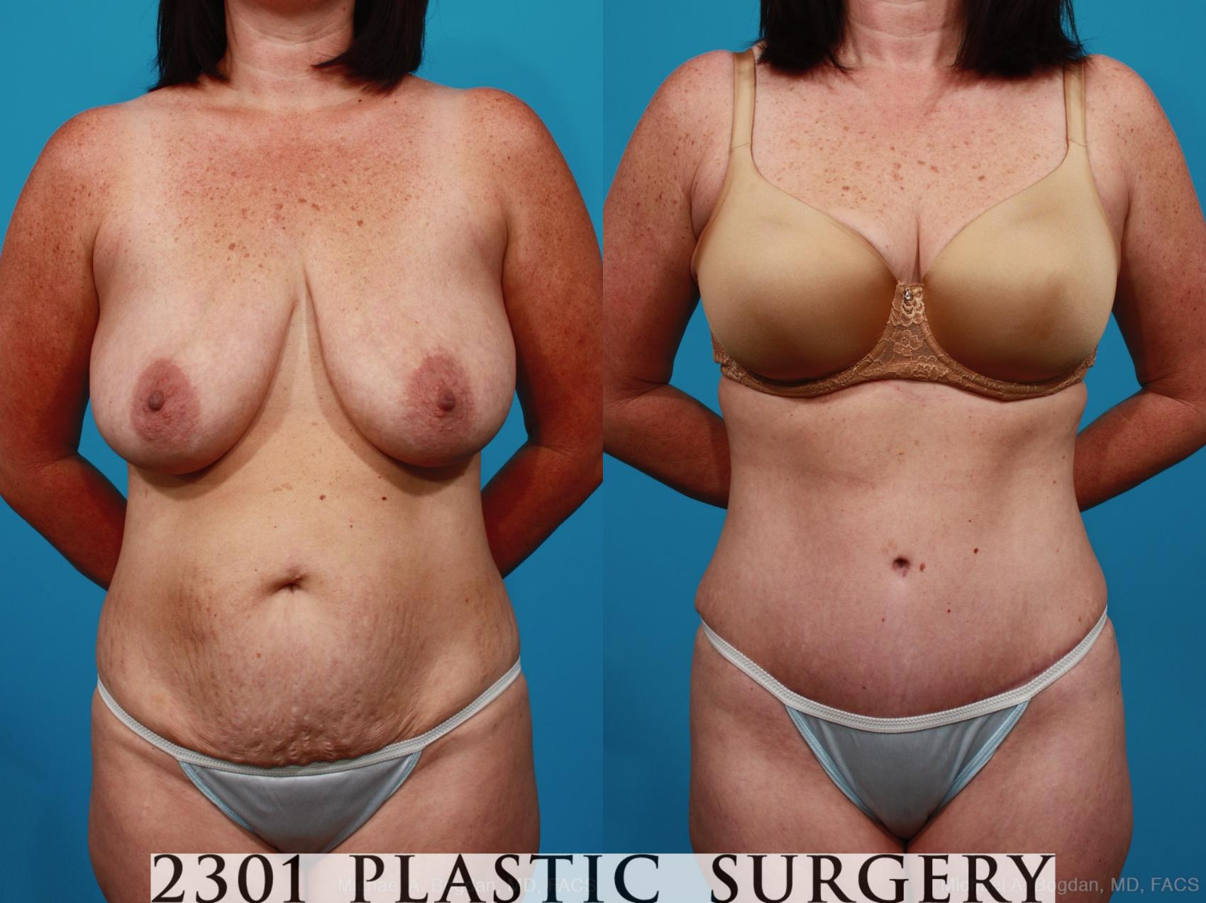 Before & After Tummy Tuck Case 317 View #1 View in Fort Worth & Frisco, Texas