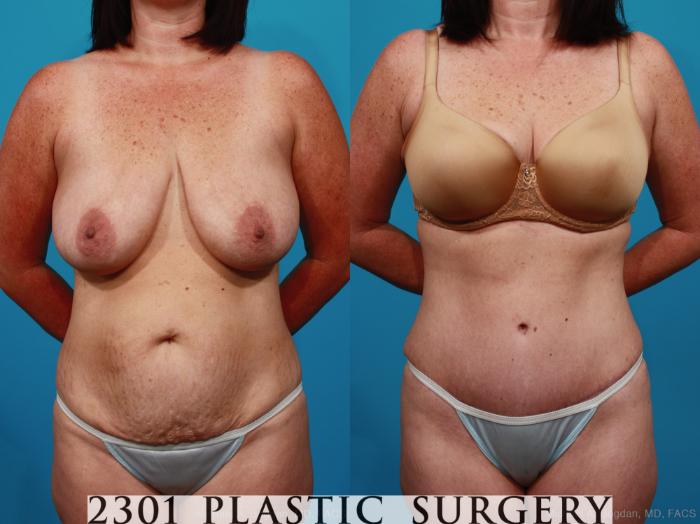 Before & After Tummy Tuck Case 317 View #1 View in Fort Worth, Plano, & Frisco, Texas
