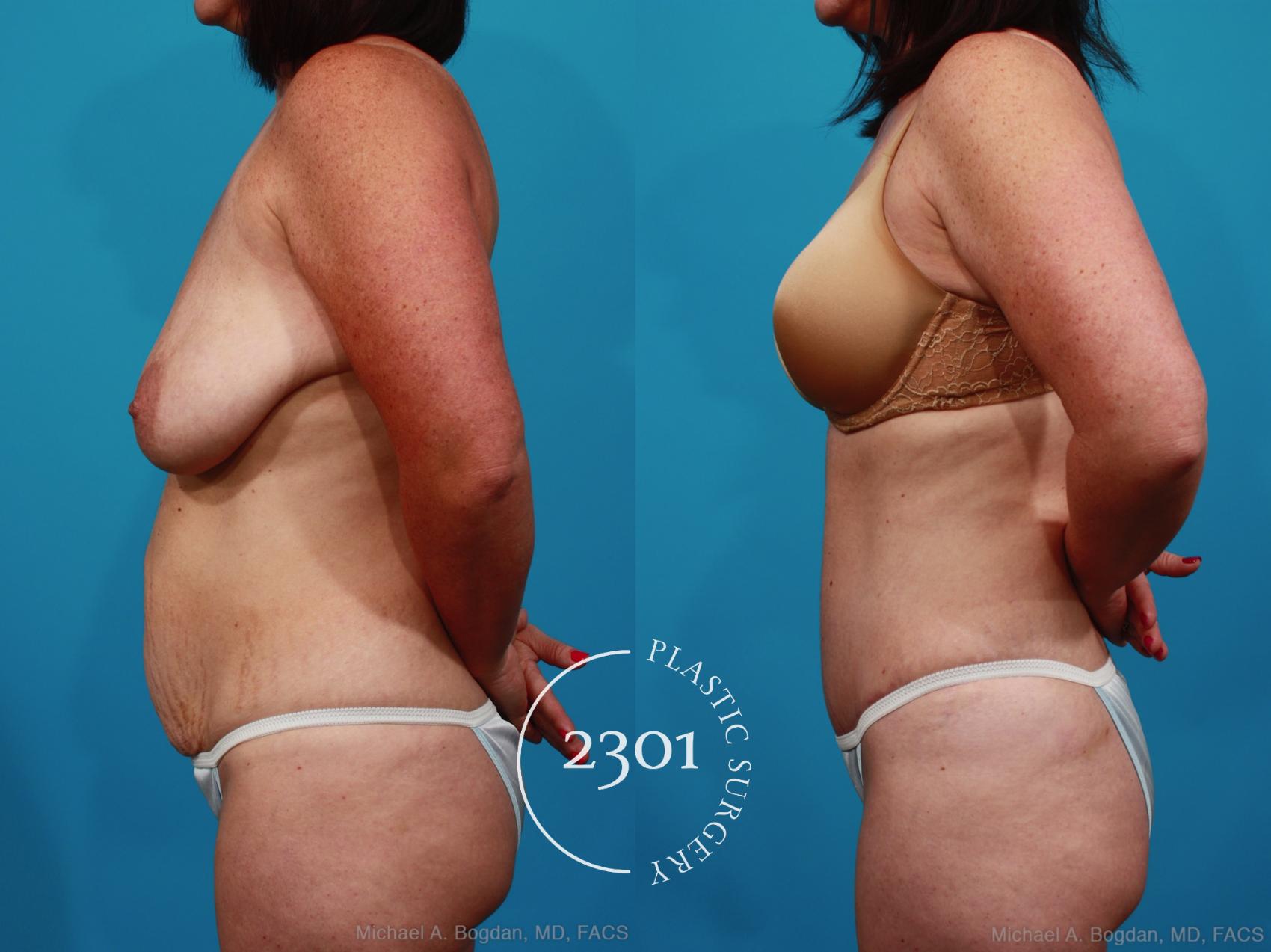Before & After Tummy Tuck Case 317 View #2 View in Fort Worth, Plano, & Frisco, Texas