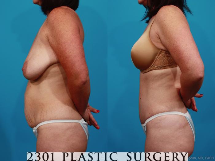 Before & After Tummy Tuck Case 317 View #2 View in Fort Worth, Plano, & Frisco, Texas