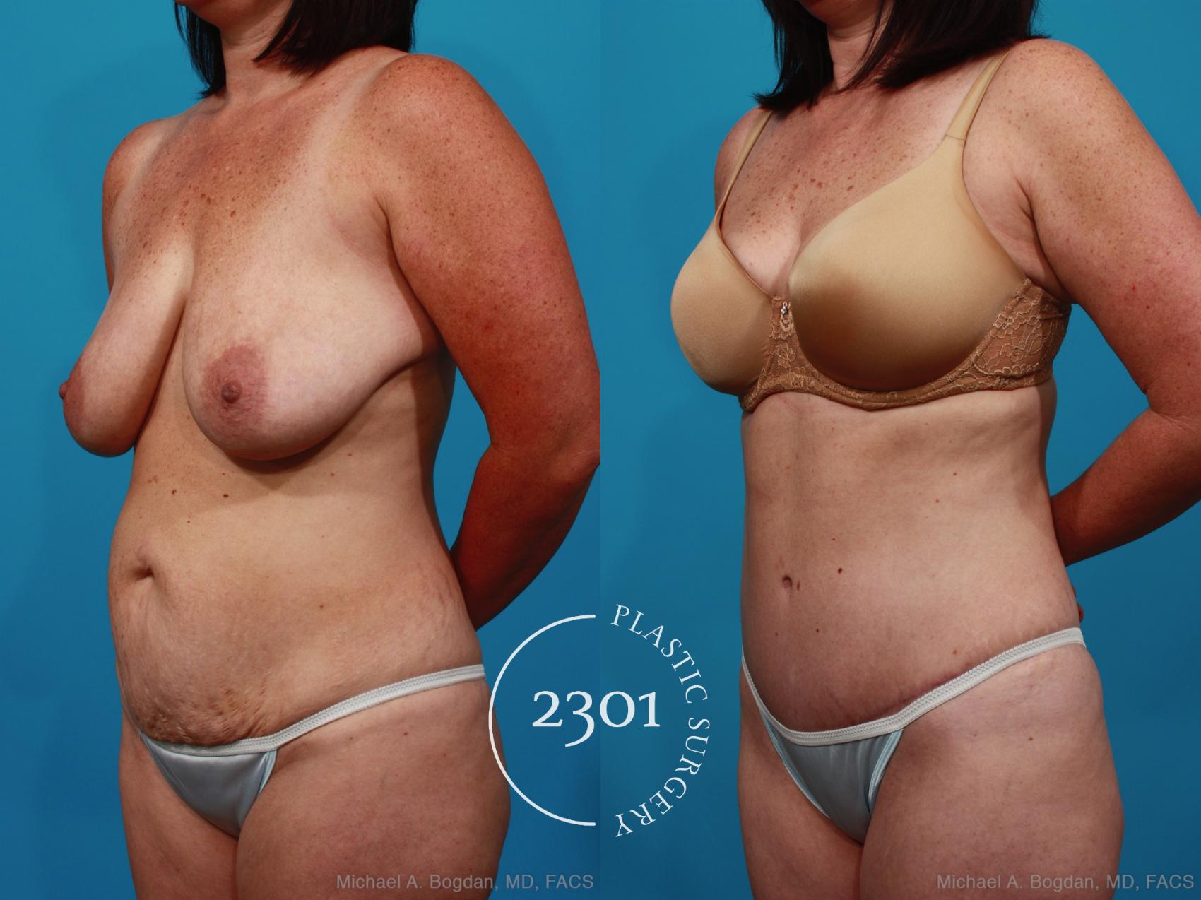 Before & After Tummy Tuck Case 317 View #3 View in Fort Worth, Plano, & Frisco, Texas