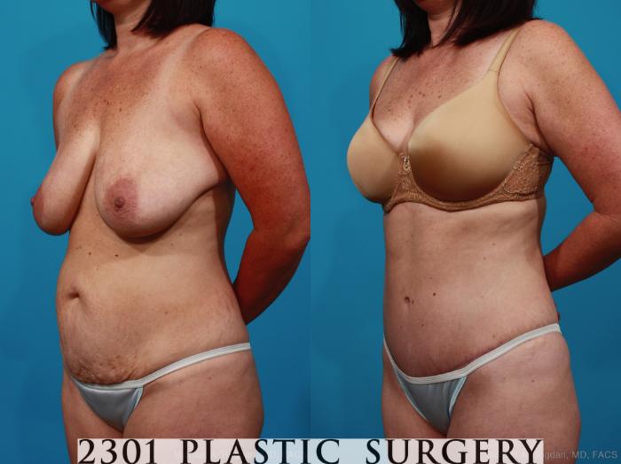 Before & After Tummy Tuck Case 317 View #3 View in Fort Worth, Plano, & Frisco, Texas