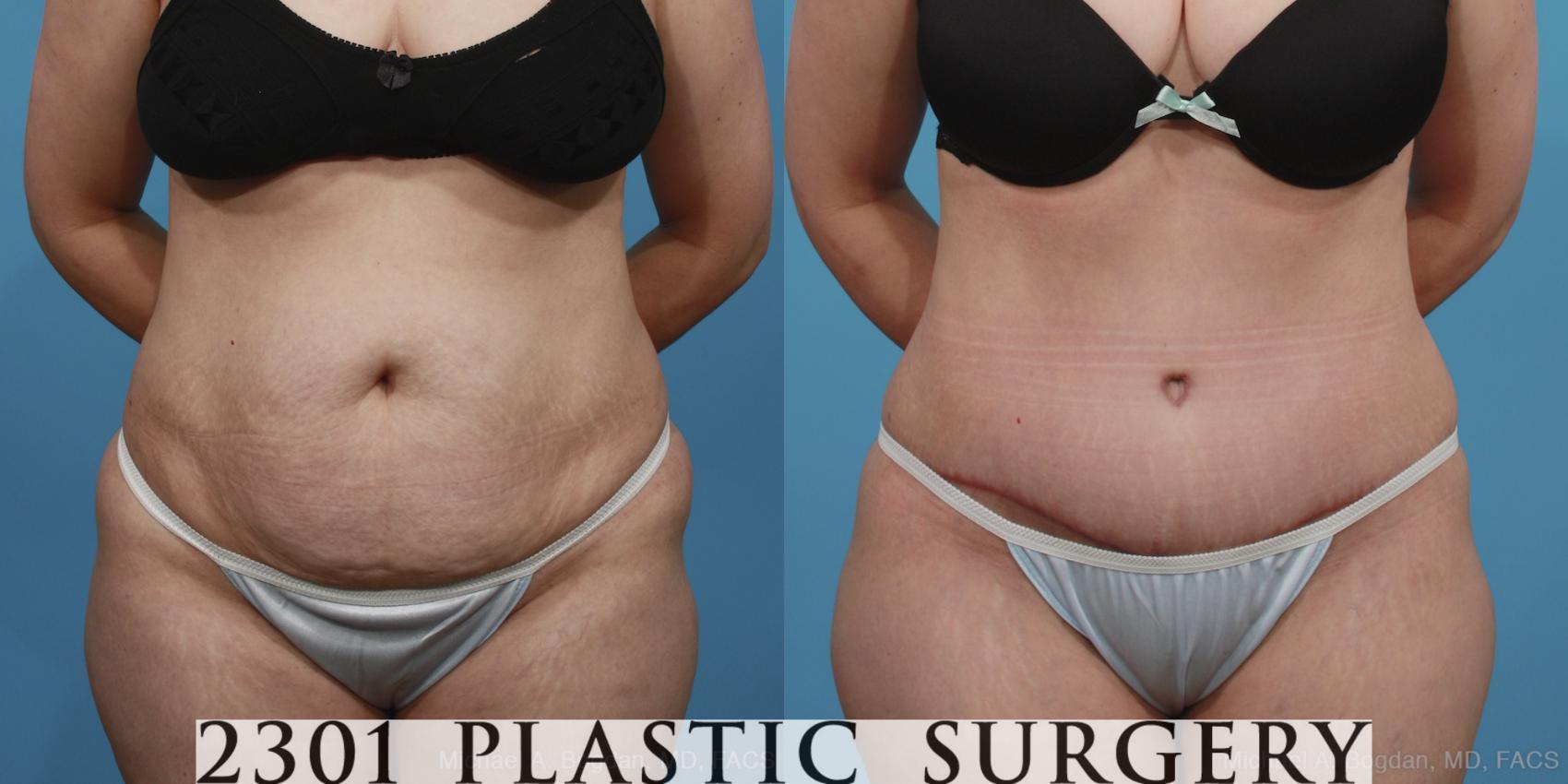 Before & After Tummy Tuck Case 369 View #1 View in Fort Worth & Frisco, Texas