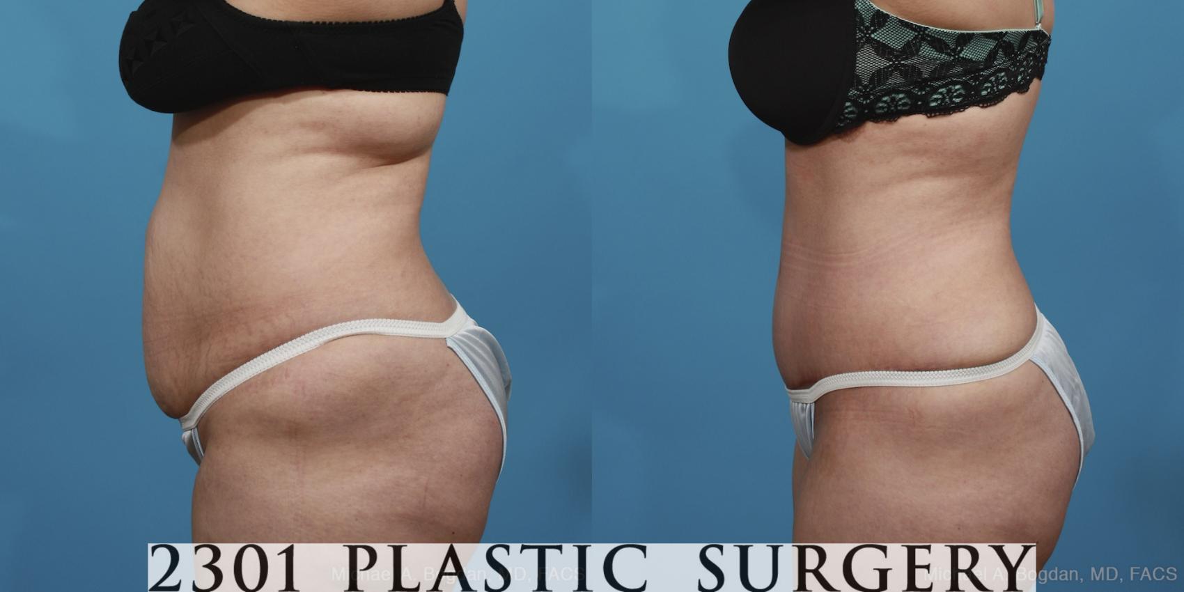 Before & After Tummy Tuck Case 369 View #2 View in Fort Worth & Frisco, Texas