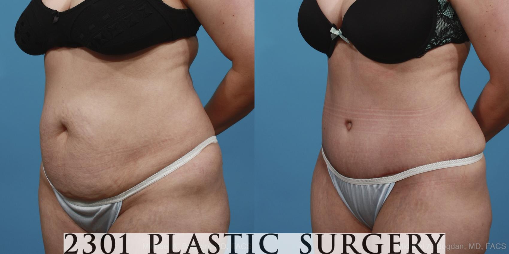 Before & After Tummy Tuck Case 369 View #3 View in Fort Worth & Frisco, Texas